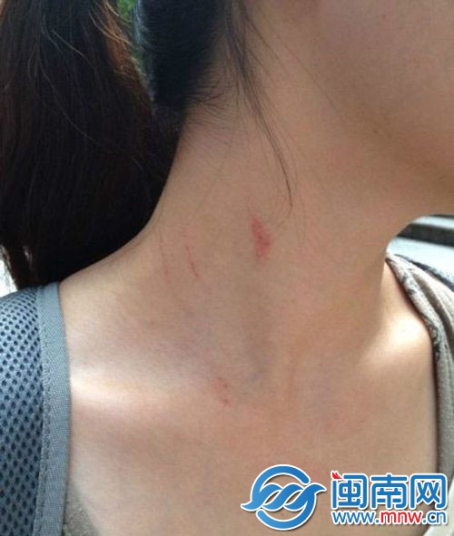 李女士脖子被抓傷