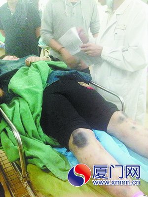 傷者鄭女士全身多處嚴(yán)重淤青