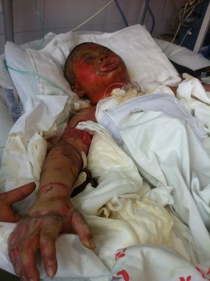 廈門17歲少女吃烤魚被燒成火人2