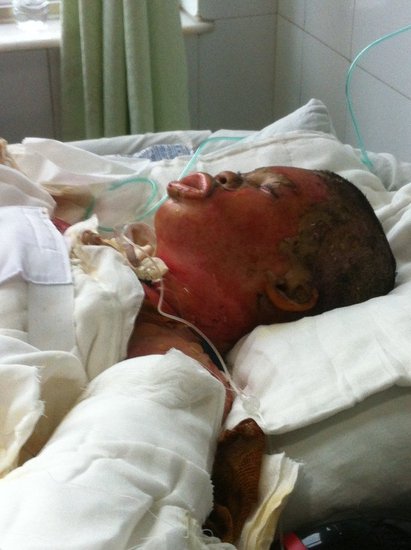 廈門17歲少女吃烤魚被燒成火人3