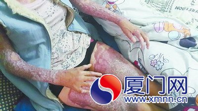 被燒傷后慘不忍睹