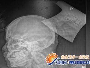 X光片顯示利斧深入頭顱