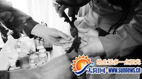 戒指卡手紅腫化膿