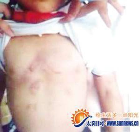 小雨身上多處傷痕。