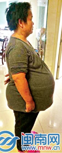 入院時(shí)，身高153cm的姚女士腹圍達(dá)到158cm