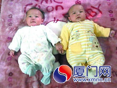 廈患巨結腸雙胞胎女嬰已恢復正常